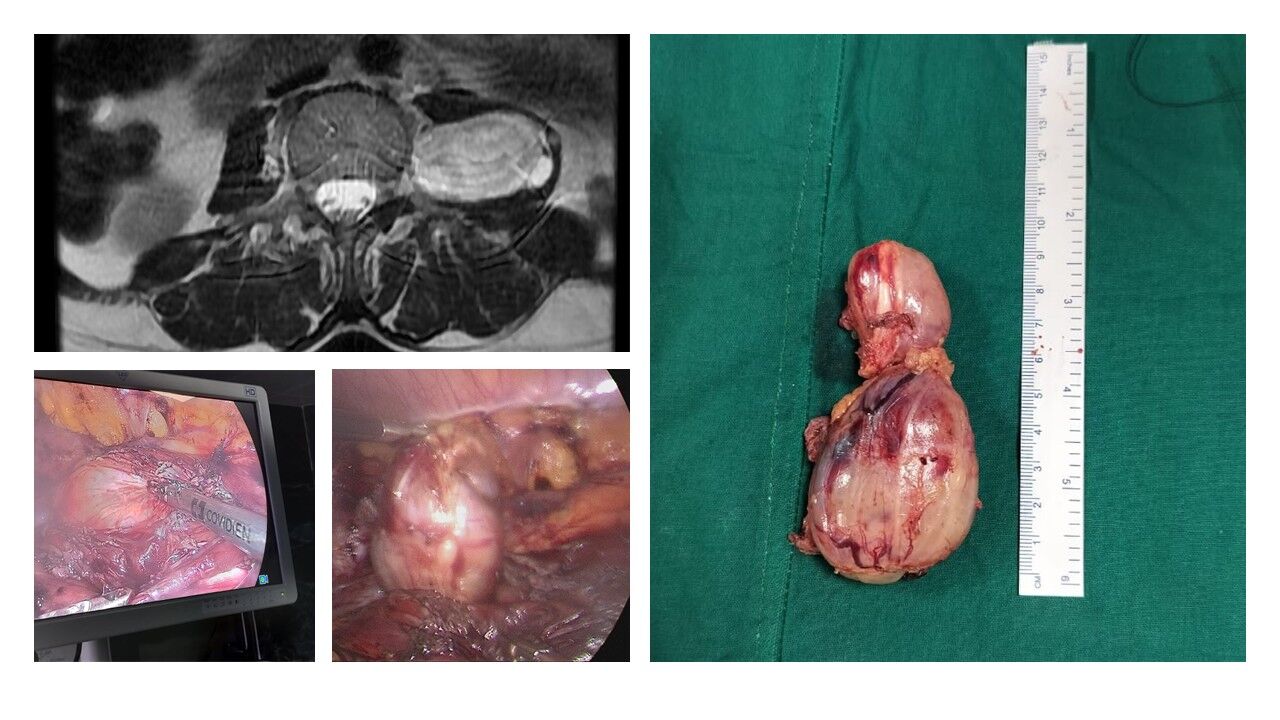laparoscopic-removal-of-lumbar-paraspinal-schwannoma--dr-pavan-kumar-image