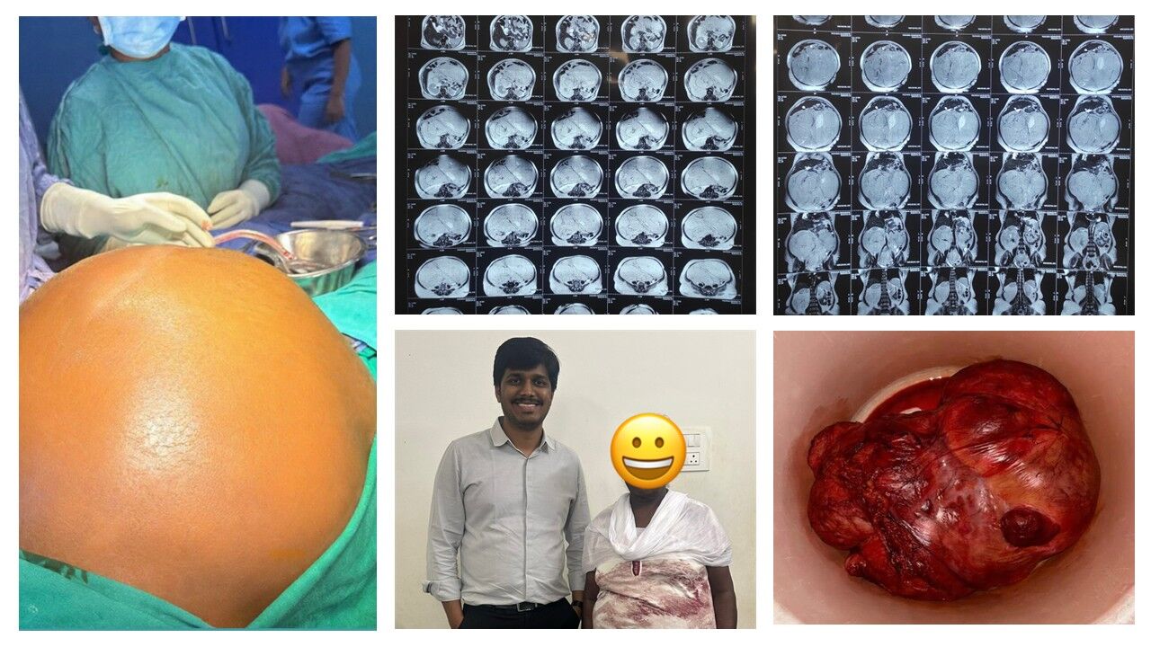 Retroperitoneal Liposarcoma Surgery | Dr Pavan Kumar
