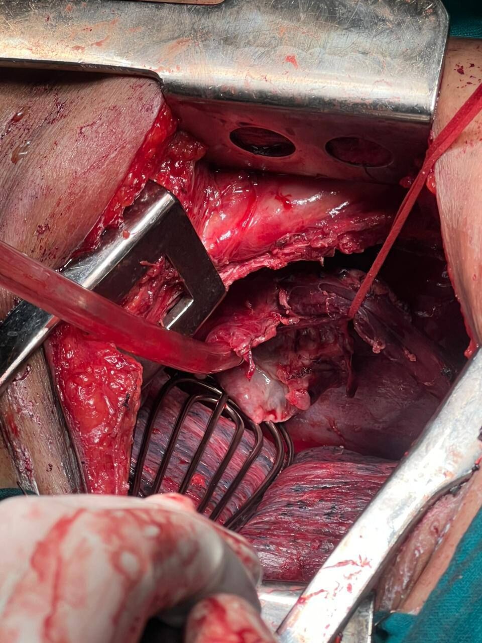 Emergency Transthoracic  Esophagectomy for Perforated Esophageal Cancer | Dr Pavan Kumar