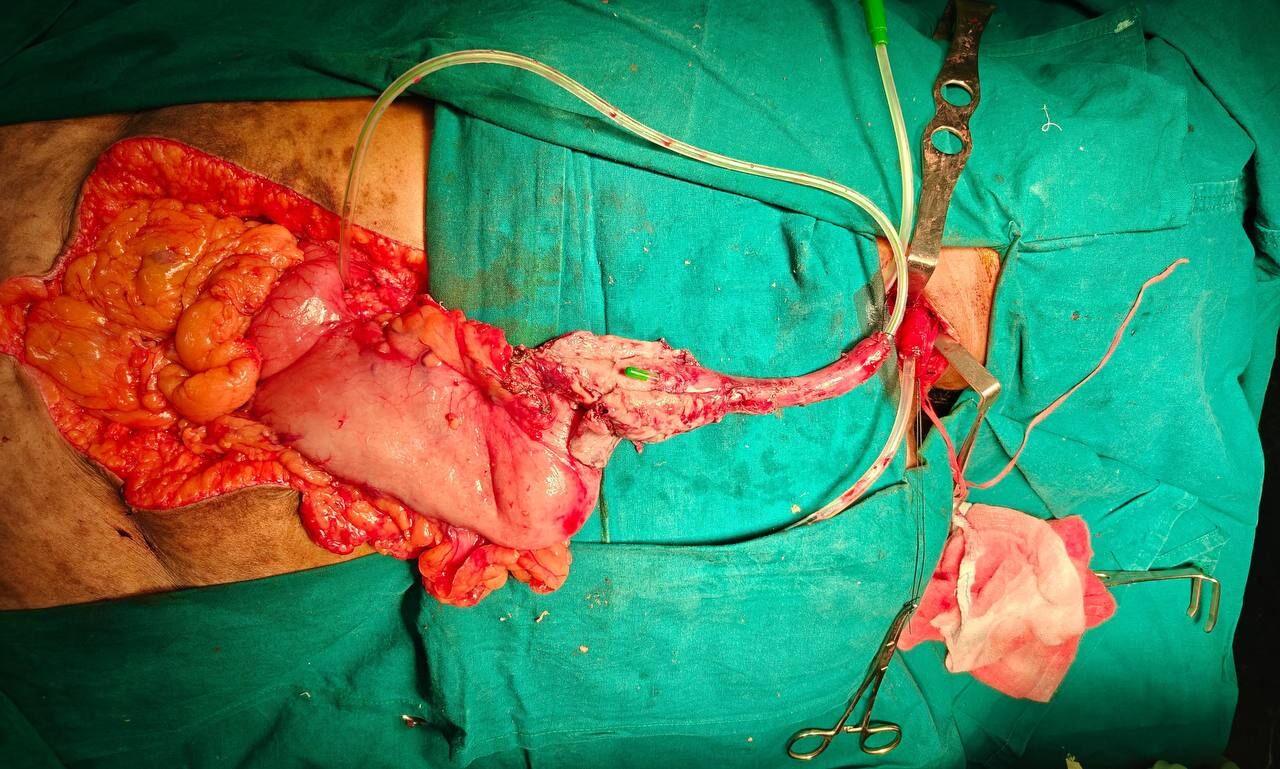 emergency-transthoracic--esophagectomy-for-perforated-esophageal-cancer--dr-pavan-kumar-image