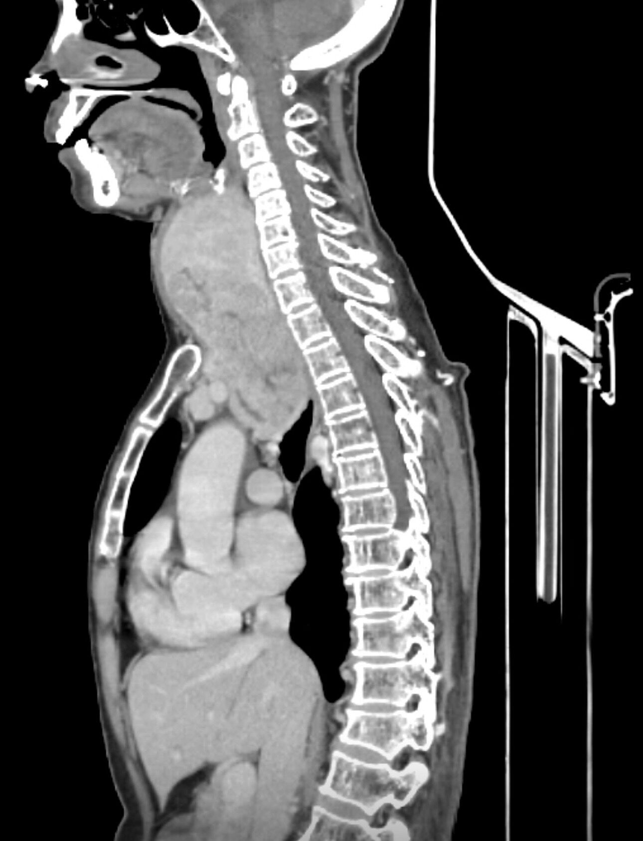 Most Retrosternal Goitres Can Be Removed Through the Neck: A Challenging Case of Giant Retrosternal Goitre